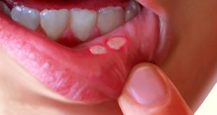 العلاج الطبيعي لقرحة الفم